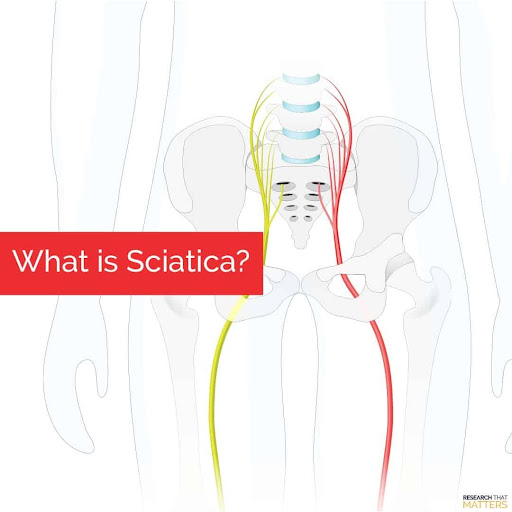 What-is-sciatica