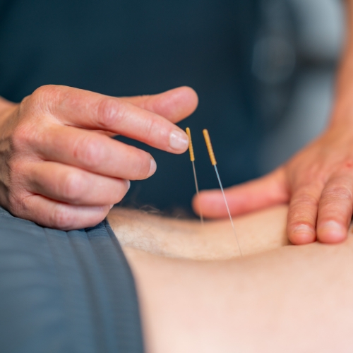 Dry Needling